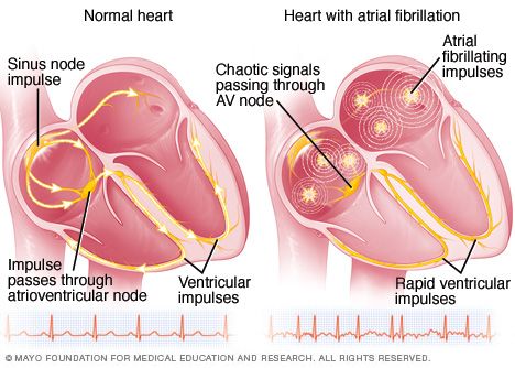 ATRIAL FIBRILLATION mcdc11_heartforafib